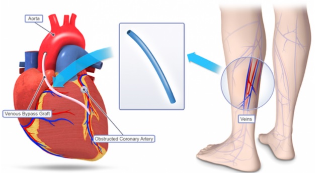 Tips to Getting Prepared for Heart Bypass Surgery