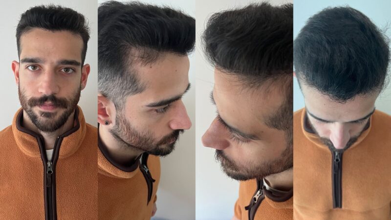 Exploring the Costs and Benefits of Hair Transplants in London