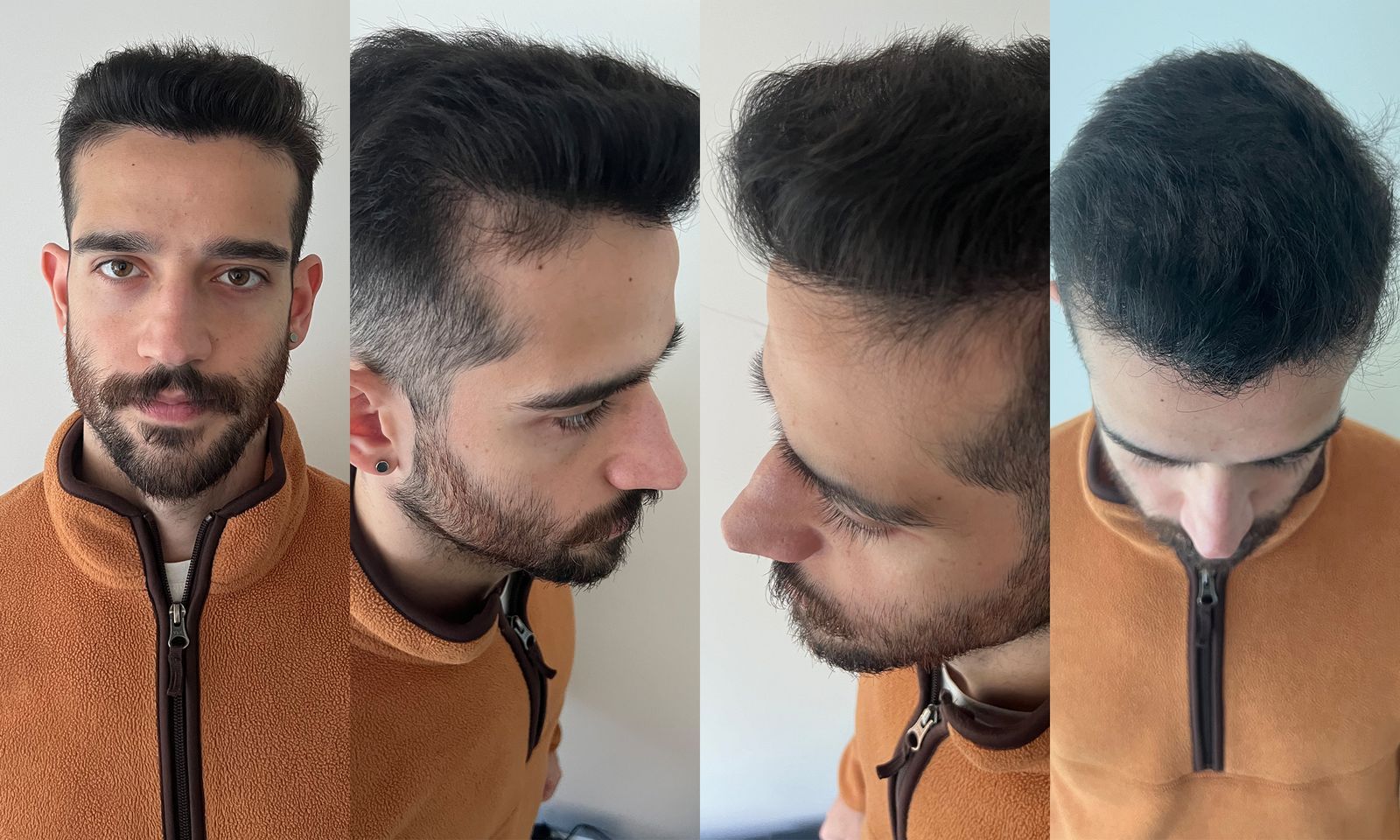 Exploring the Costs and Benefits of Hair Transplants in London