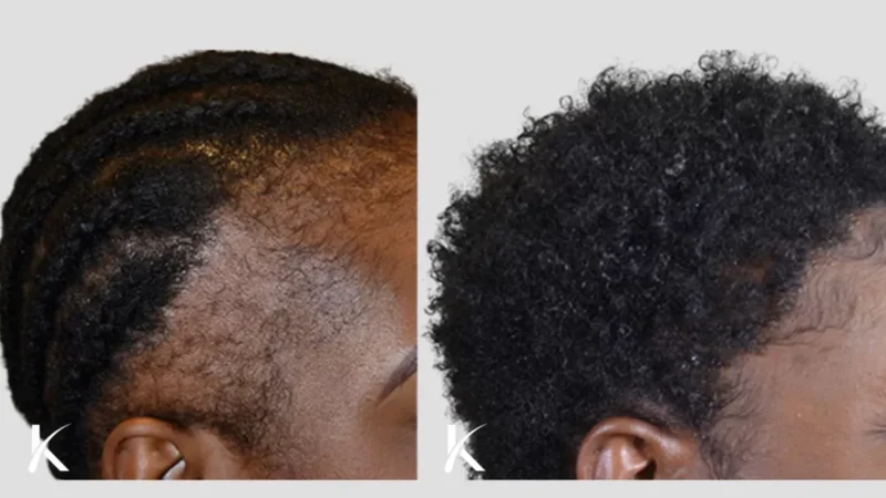 How to Identify the Best Hair Transplant Options in London