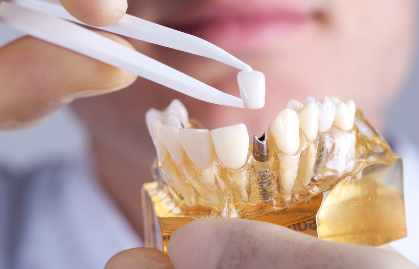 Your Complete Guide to Finding the Perfect Dental Clinic for Implant Success