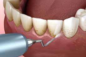 Tooth Scaling