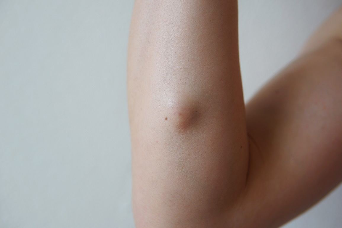 Self-Care and Monitoring: How to Handle Lipomas at Home Before Consulting a Doctor