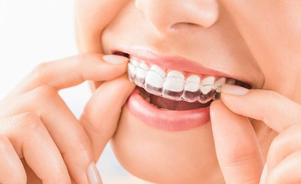 A Complete Guide to Transparent Teeth Braces: Benefits, Care, and Expectations